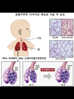 [x]호흡곤란 ·마른기침이 주증상 …간질성 폐 질환, 생명 위협 | 한국일보