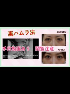 [x]裏ハムラ法の手術中動画とビフォーアフターの経過 - YouTube